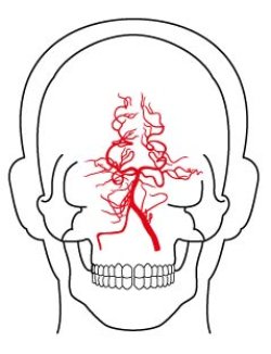 画像1: 右椎骨動脈