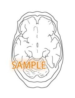 画像1: CT図-脳
