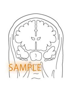 画像1: CT図-脳