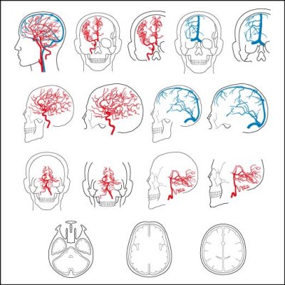 画像1: シェーマ画像-15S. 脳血管